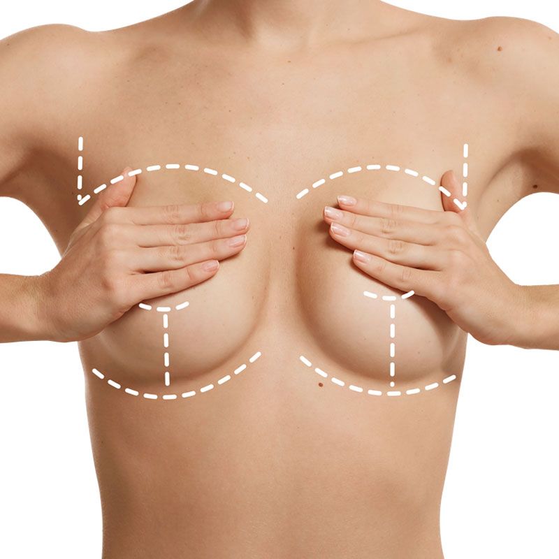 Prótesis de mama por encima o por debajo del músculo ¿Qué es mejor?